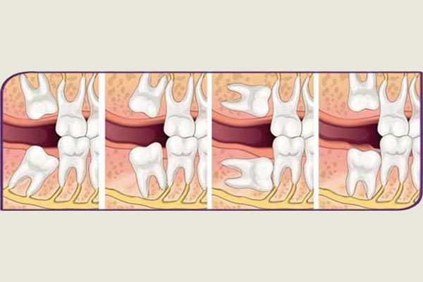 Çene Cerrahisi | ConceptDent Ağız ve Diş Sağlığı Polikliniği